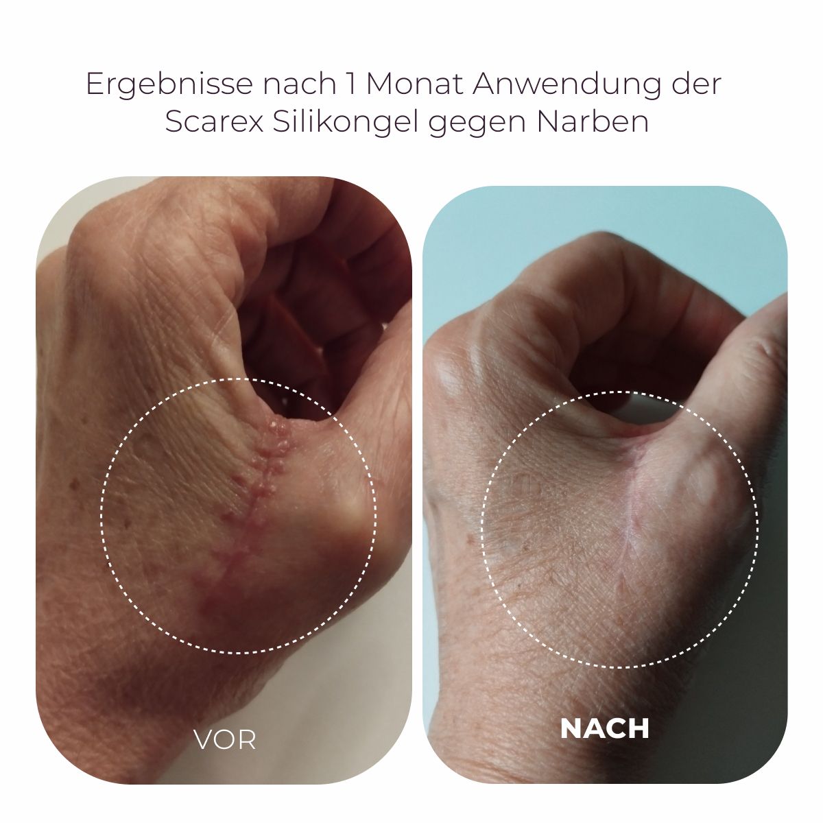 Biotrade Scarex Silikongel für Narben Mini