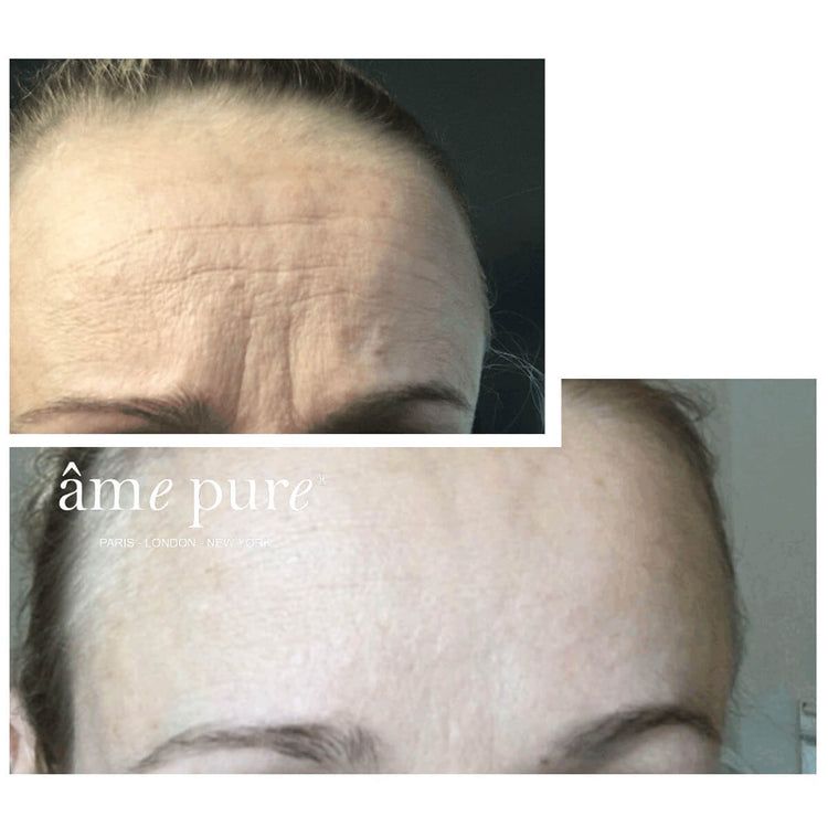 Vorher-Nachher-Bild. Stirn mit Falten, dann glatte Haut. Marke: âme pure.