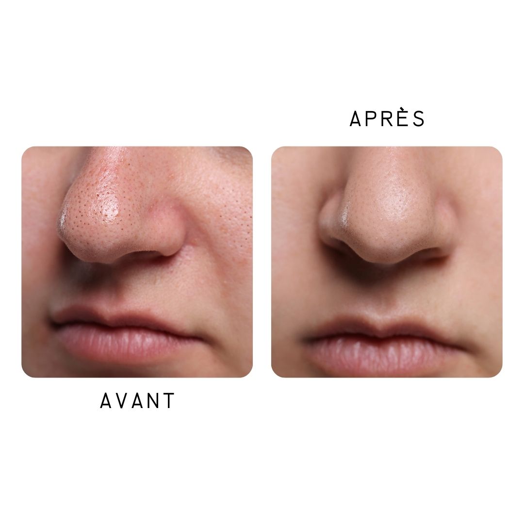 Deux gros plans de nez. Gauche : Avant, avec pores. Droite : Après, peau lisse.