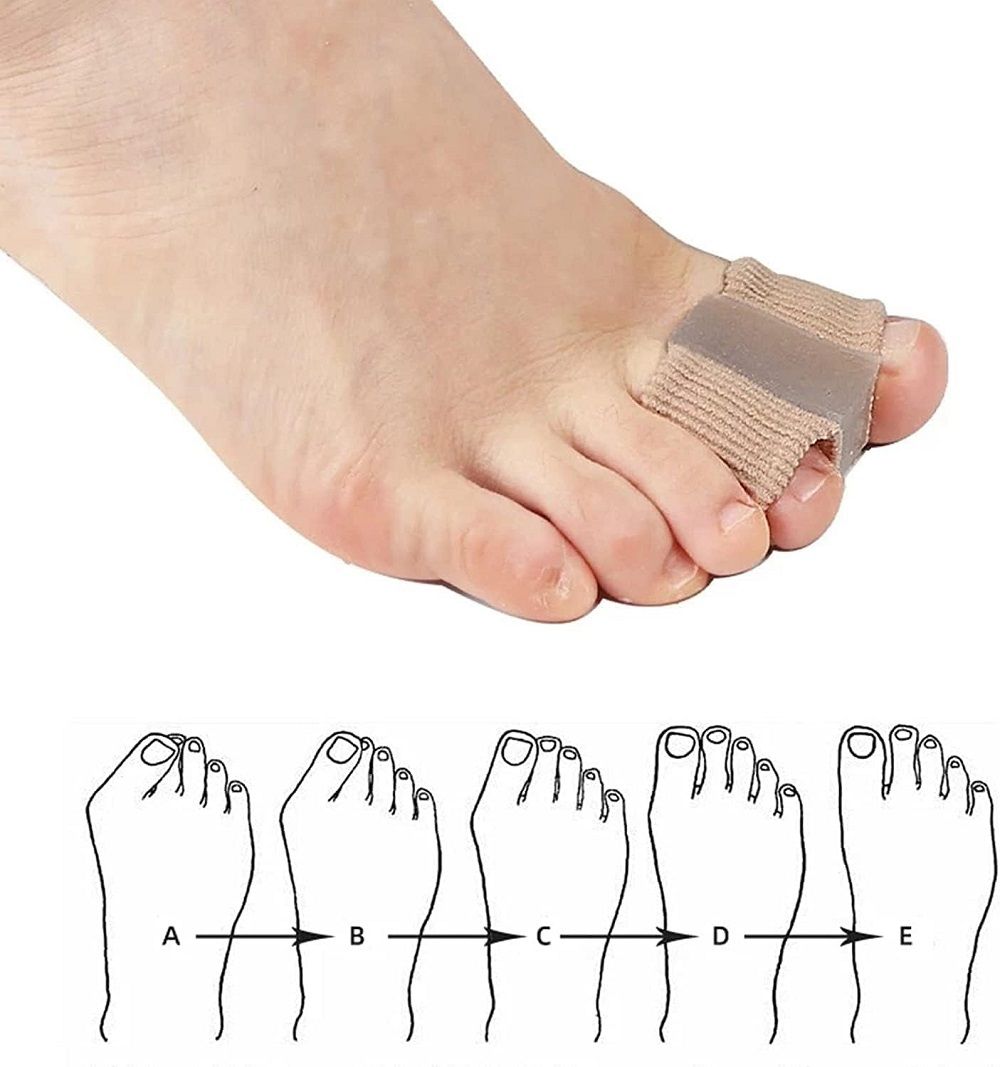 Fuß mit Zehenspreizer. Unterhalb Illustrationen verschiedener Fußformen, markiert mit Buchstaben A bis E.