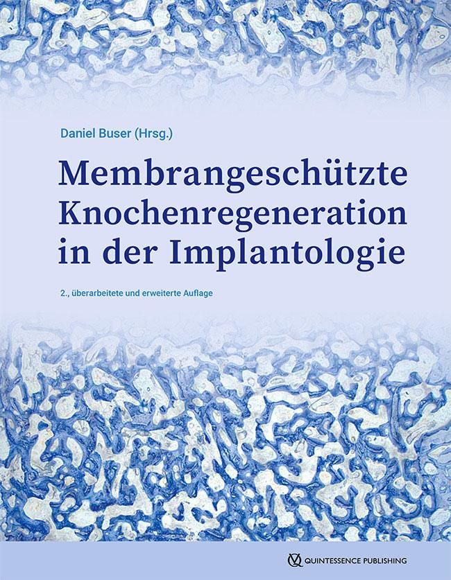 Membrangeschützte Knochenregeneration in der Implantologie Seit 35 Jahren Fortschritt und neue An...